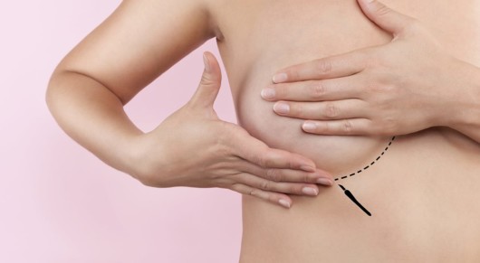 Close up picture of of girls breast with inframammary incision for breast implant